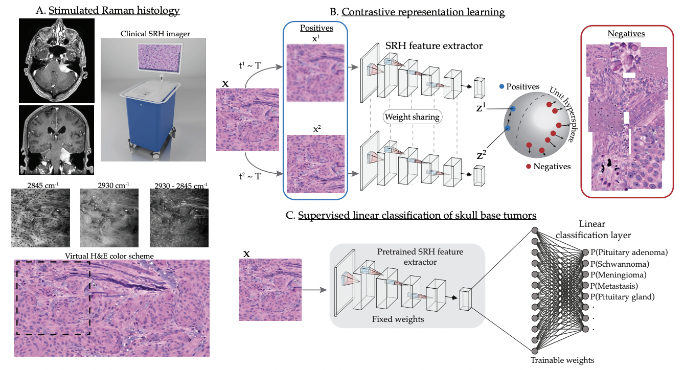 Figure from Rapid Automated Analysis of Skull Base Tumor Specimens Using Intraoperative Optical Imaging and Artificial Intelligence